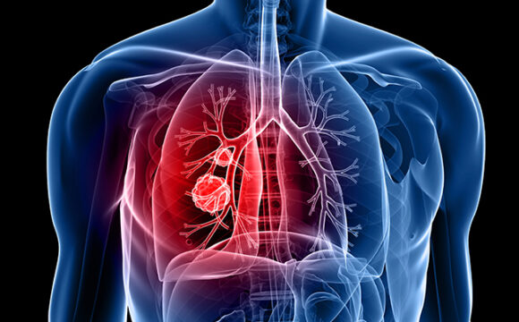 Хронічне обструктивне захворювання легень (ХОЗЛ)