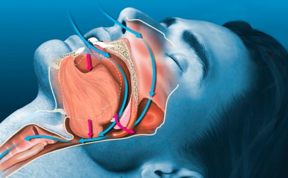 Хропіння і синдром апное сну – причини, наслідки та лікування