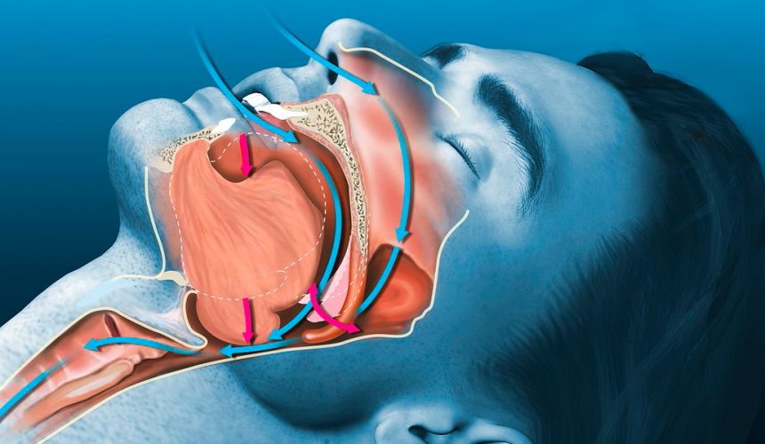 Хропіння і синдром апное сну – причини, наслідки та лікування